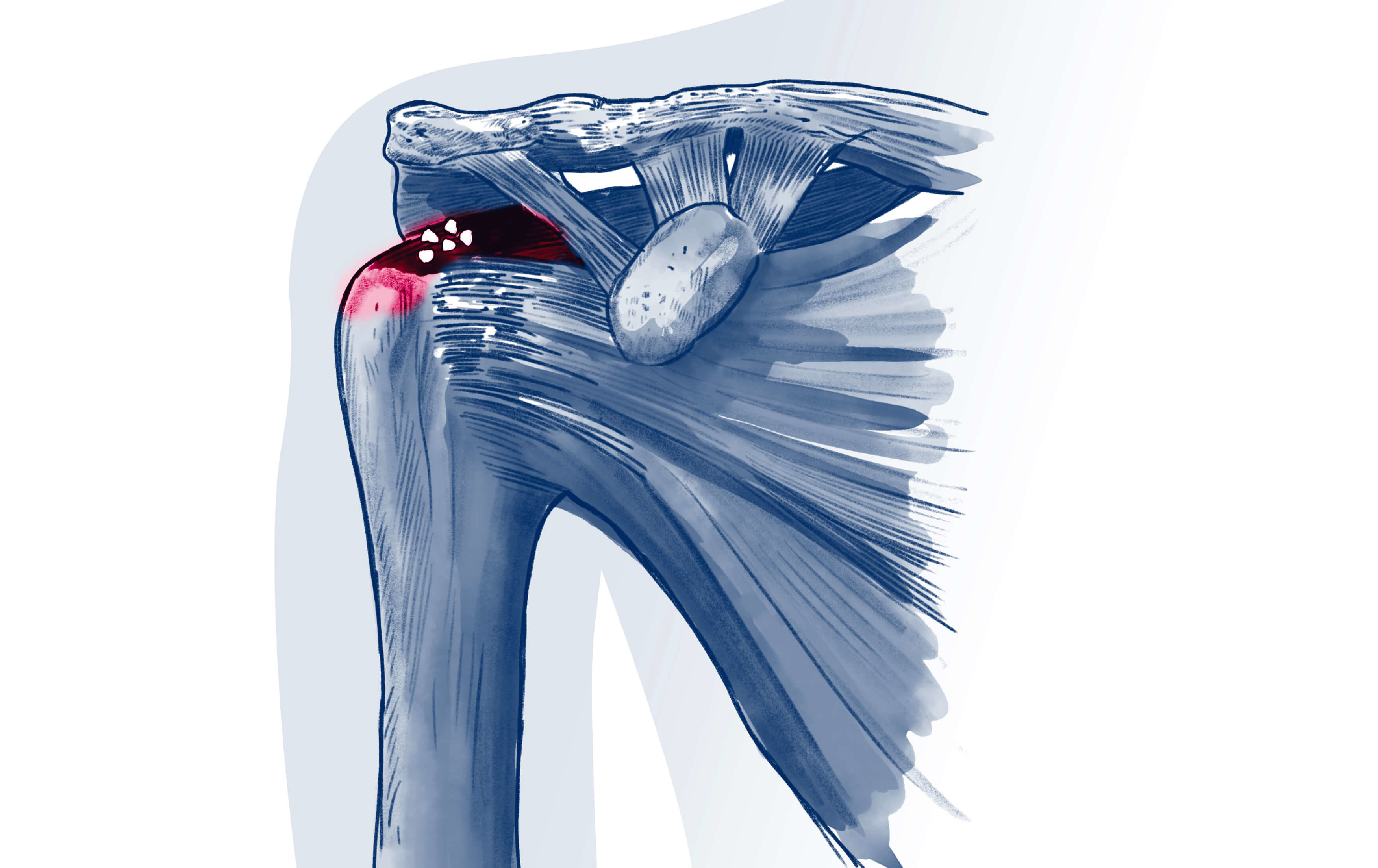 Calcification - Pathologie | ISCO Strasbourg