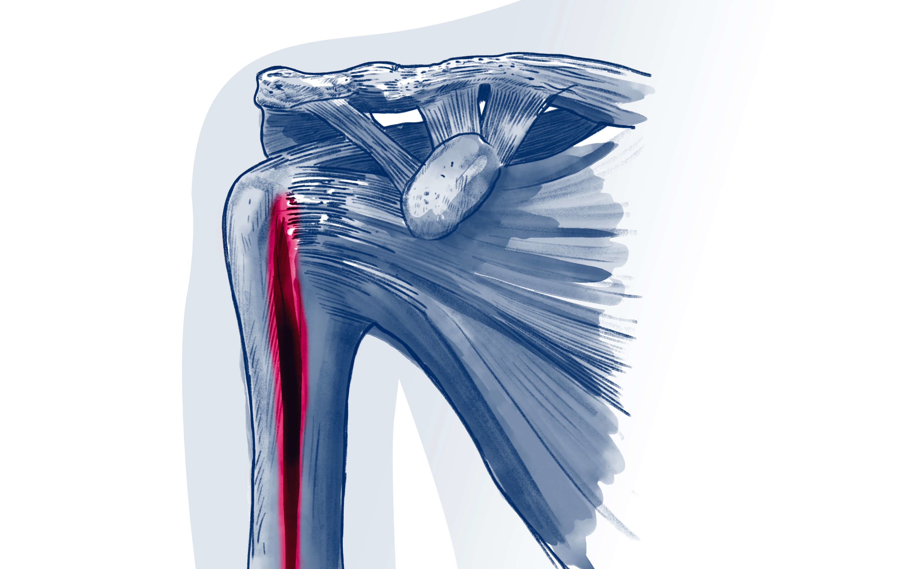 Tendinopathie du long biceps - Pathologie | ISCO Strasbourg