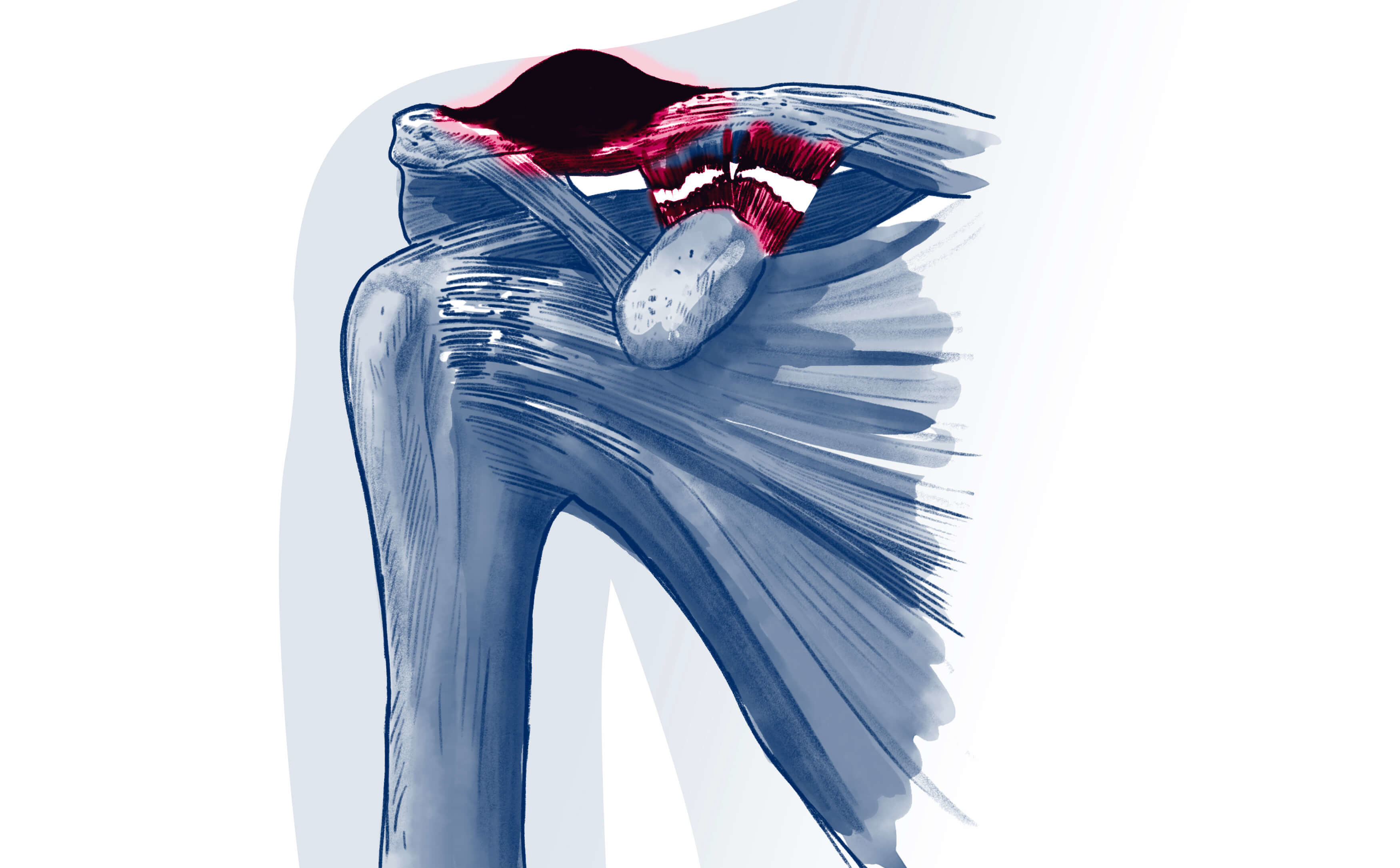 Luxation acromioclaviculaire - Pathologie | ISCO Strasbourg