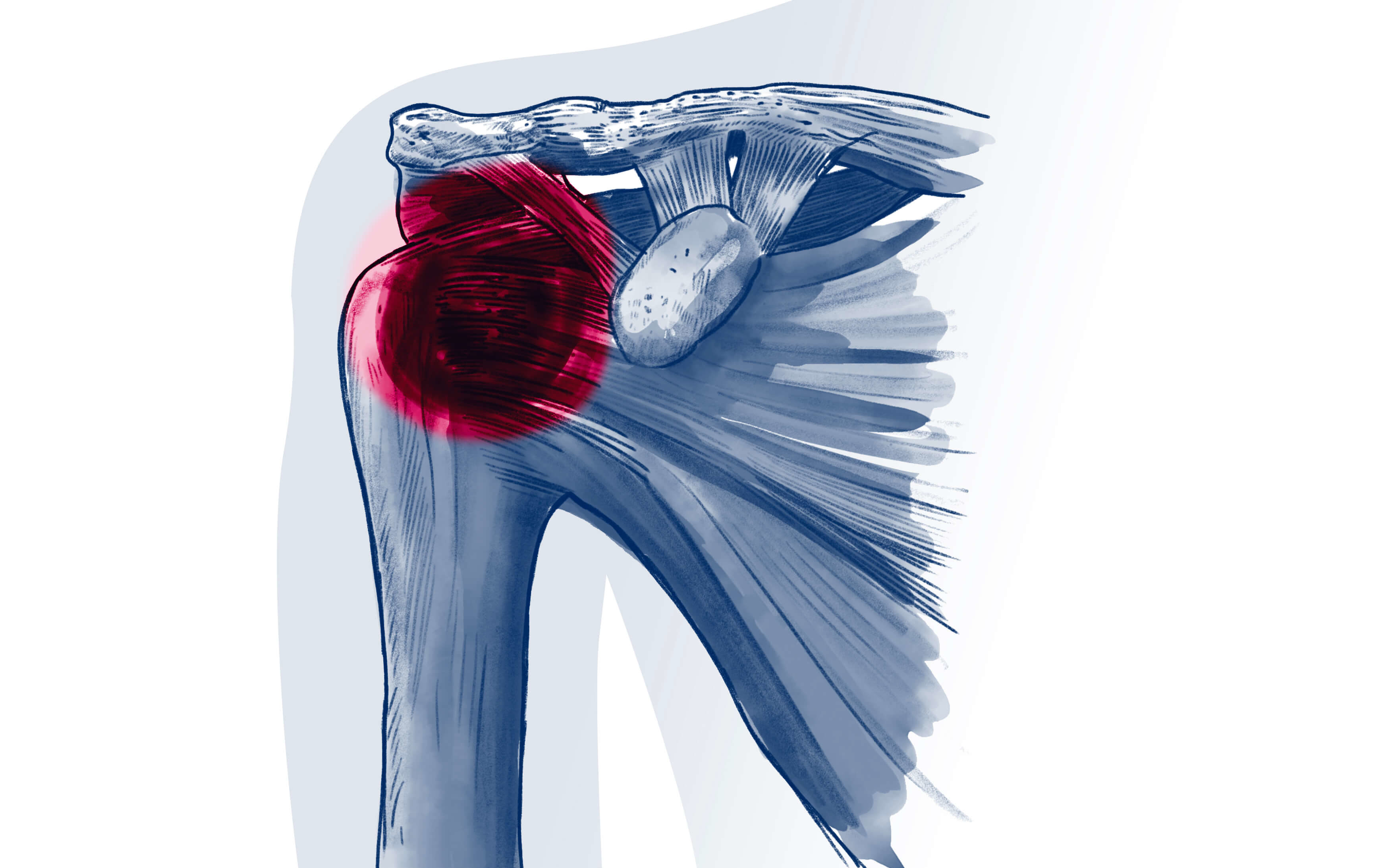 Capsulite rétractile - Pathologie | ISCO Strasbourg