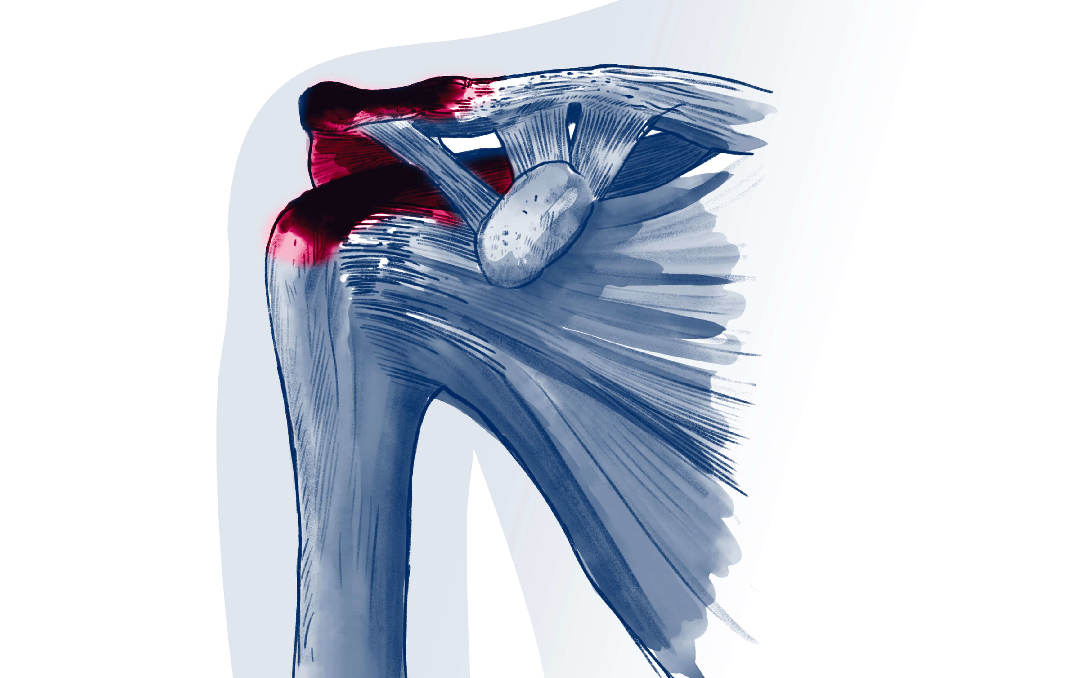 Tendinopathie non rompue de la coiffe des rotateurs - Pathologie | ISCO Strasbourg