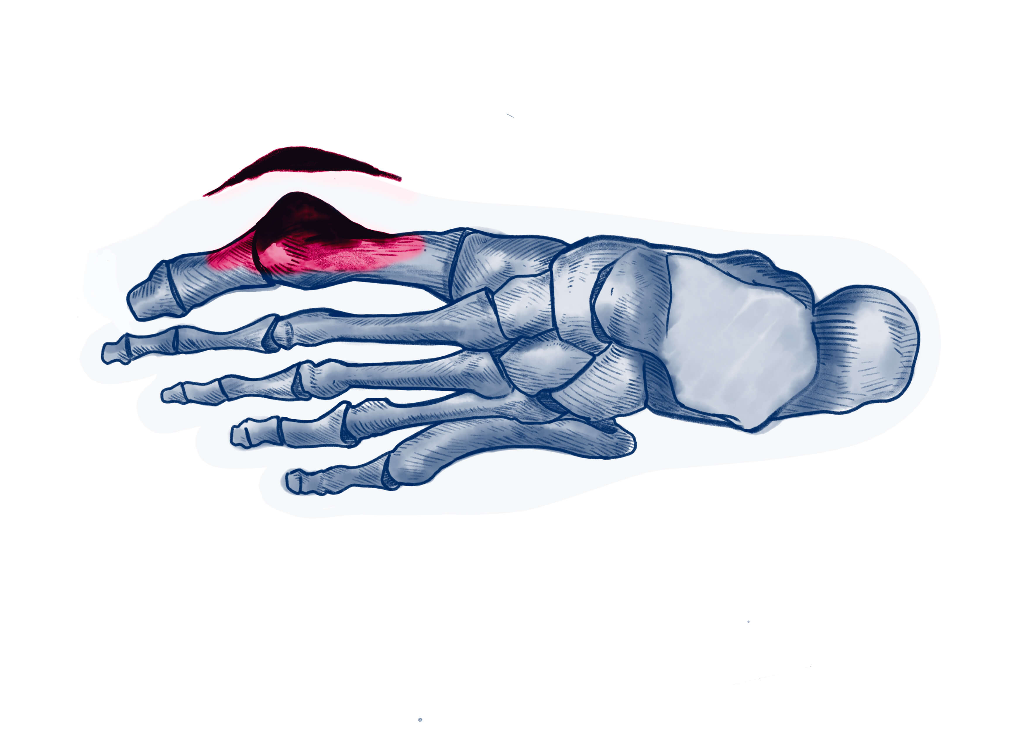 Hallux valgus - Pathologie | ISCO Strasbourg