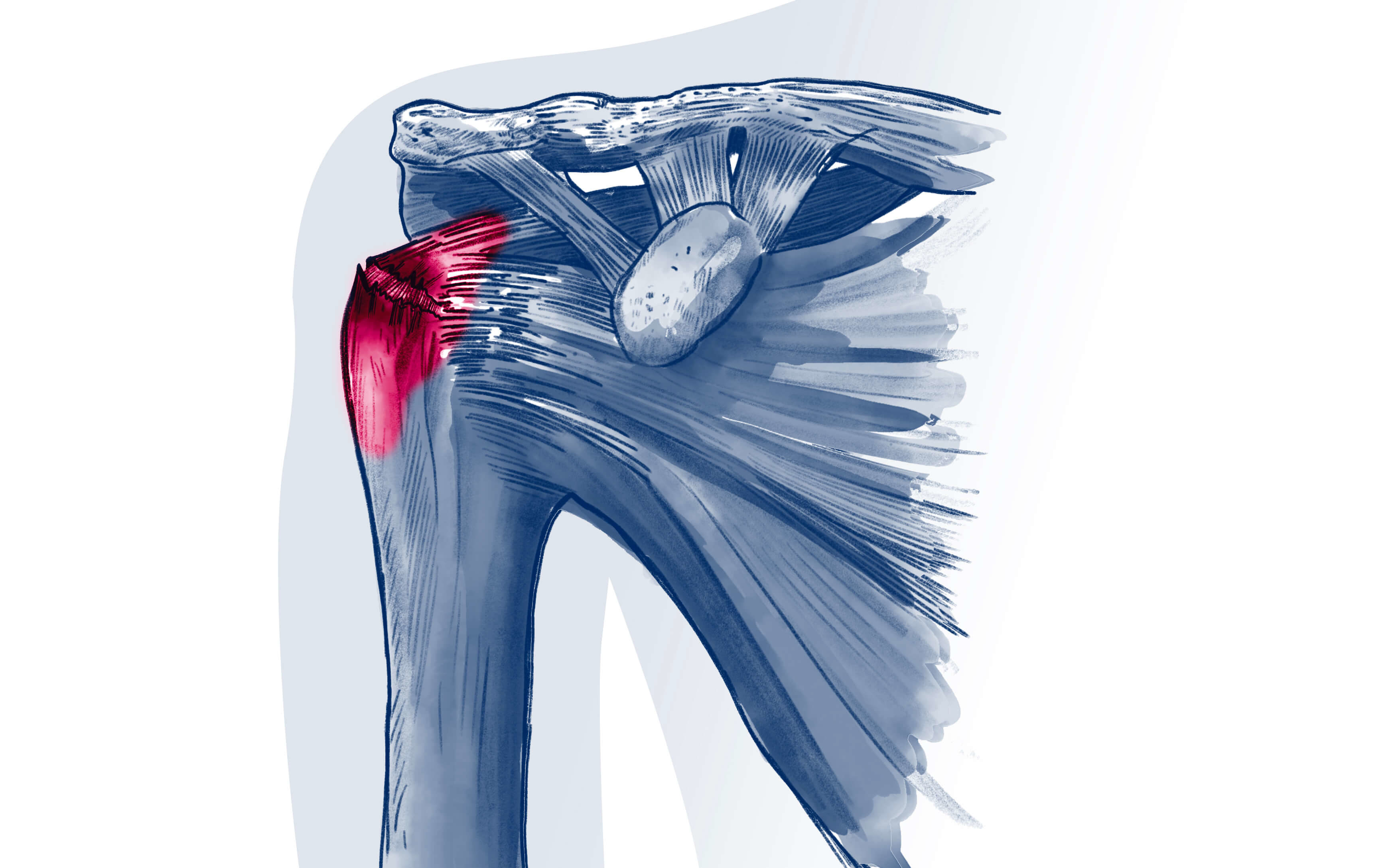 Rupture de la coiffe des rotateurs