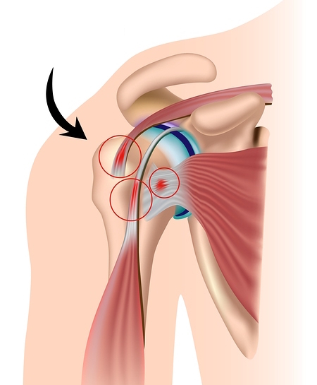 Tendinopathie du long biceps - ISCO - Institut Spécialisé de Chirurgie ...
