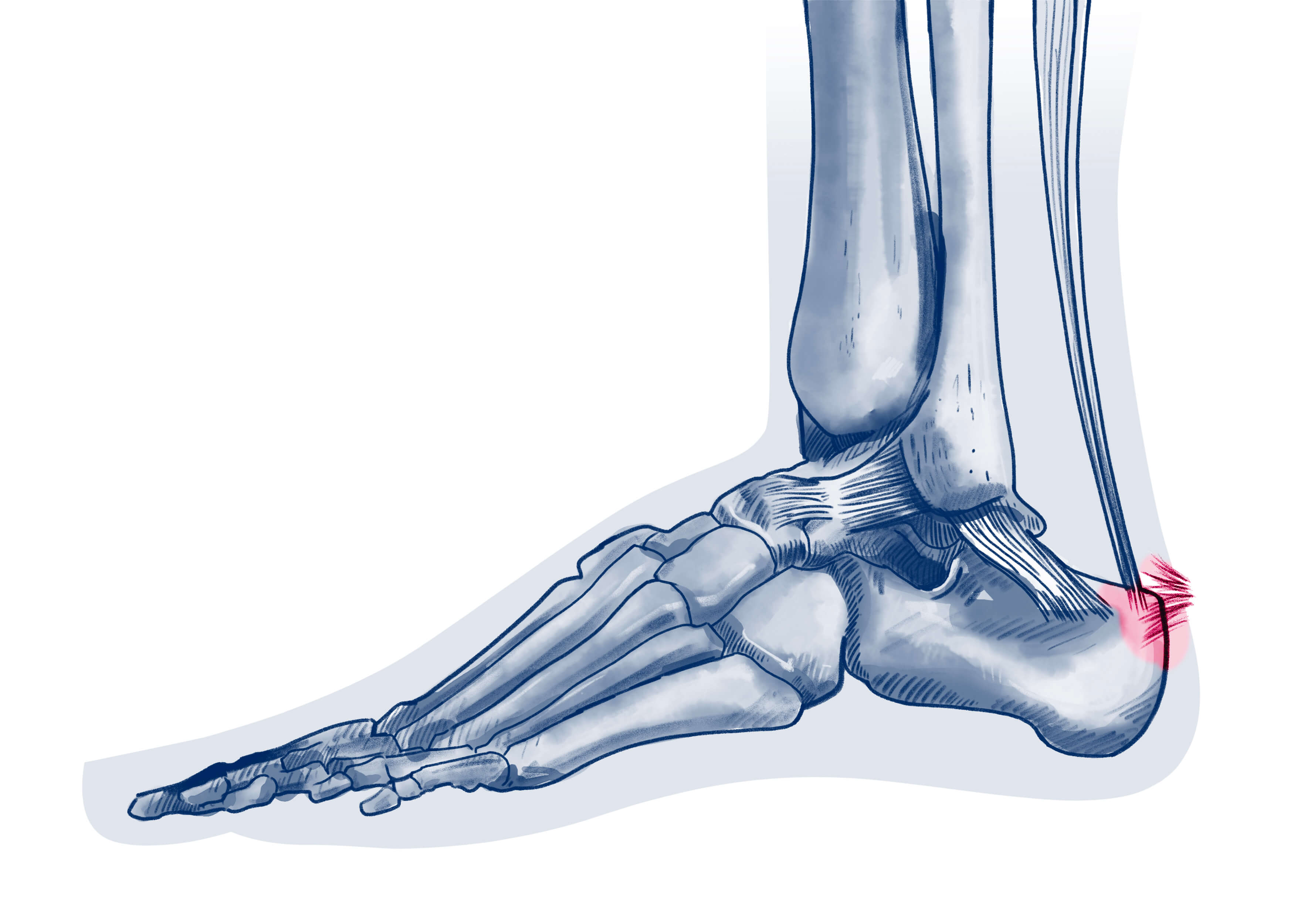 Enthésopathie d'insertion d'Achille - Pathologie | ISCO Strasbourg