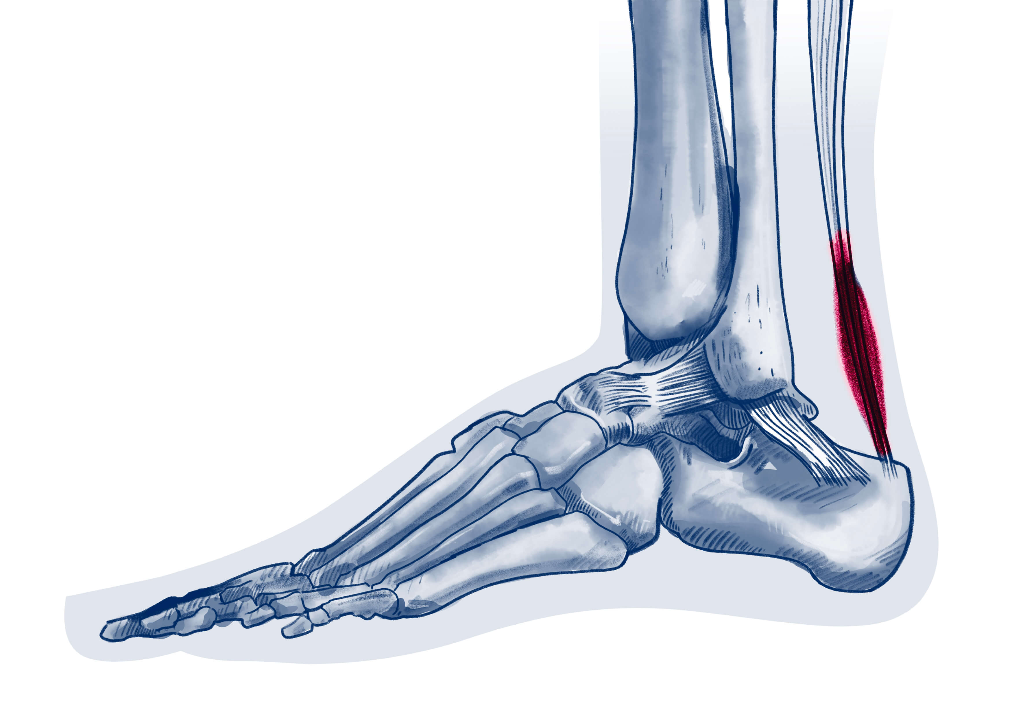 Tendinopathie du tendon d'Achille - Pathologie | ISCO Strasbourg