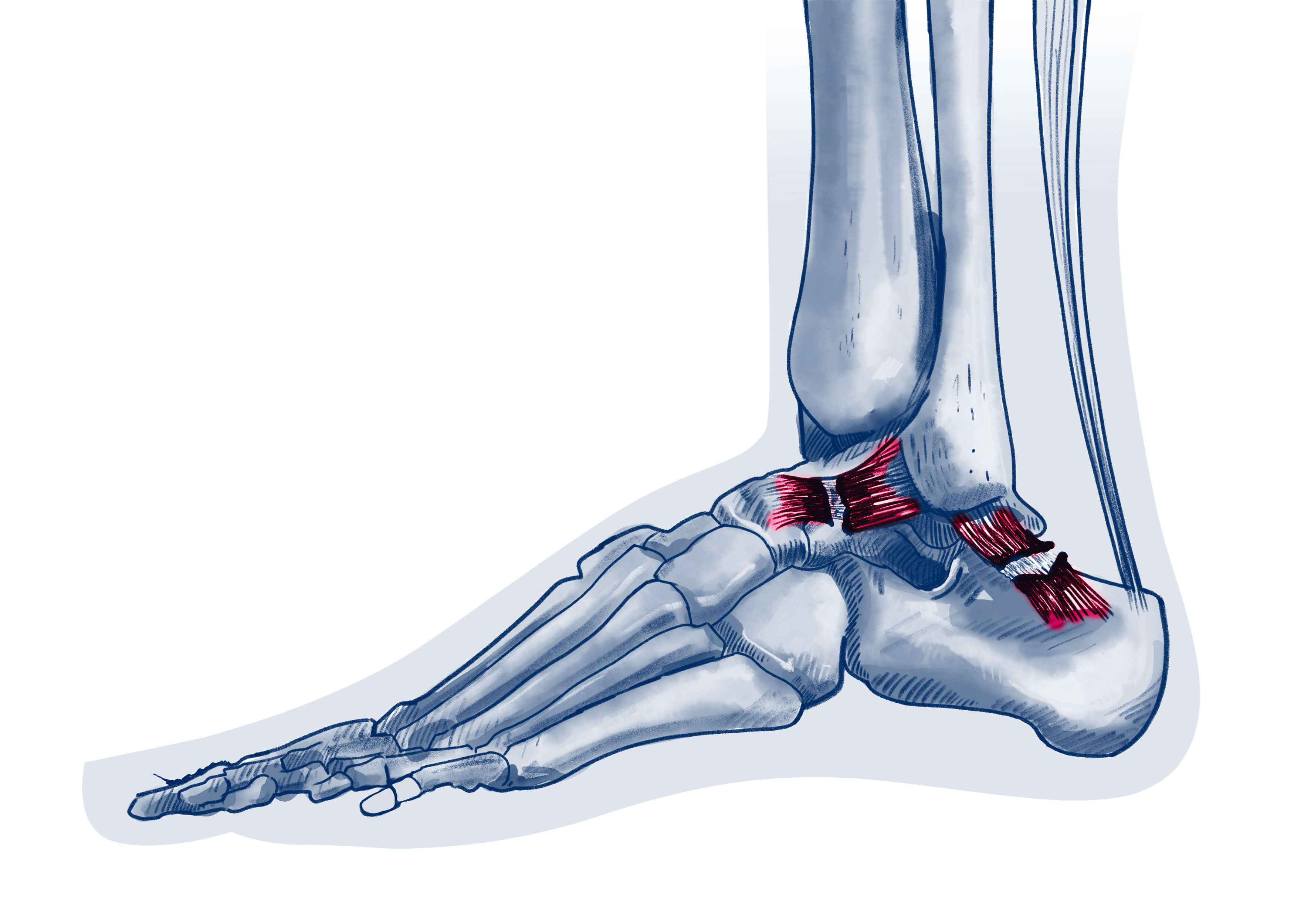 Instabilité chronique - Pathologie | ISCO Strasbourg