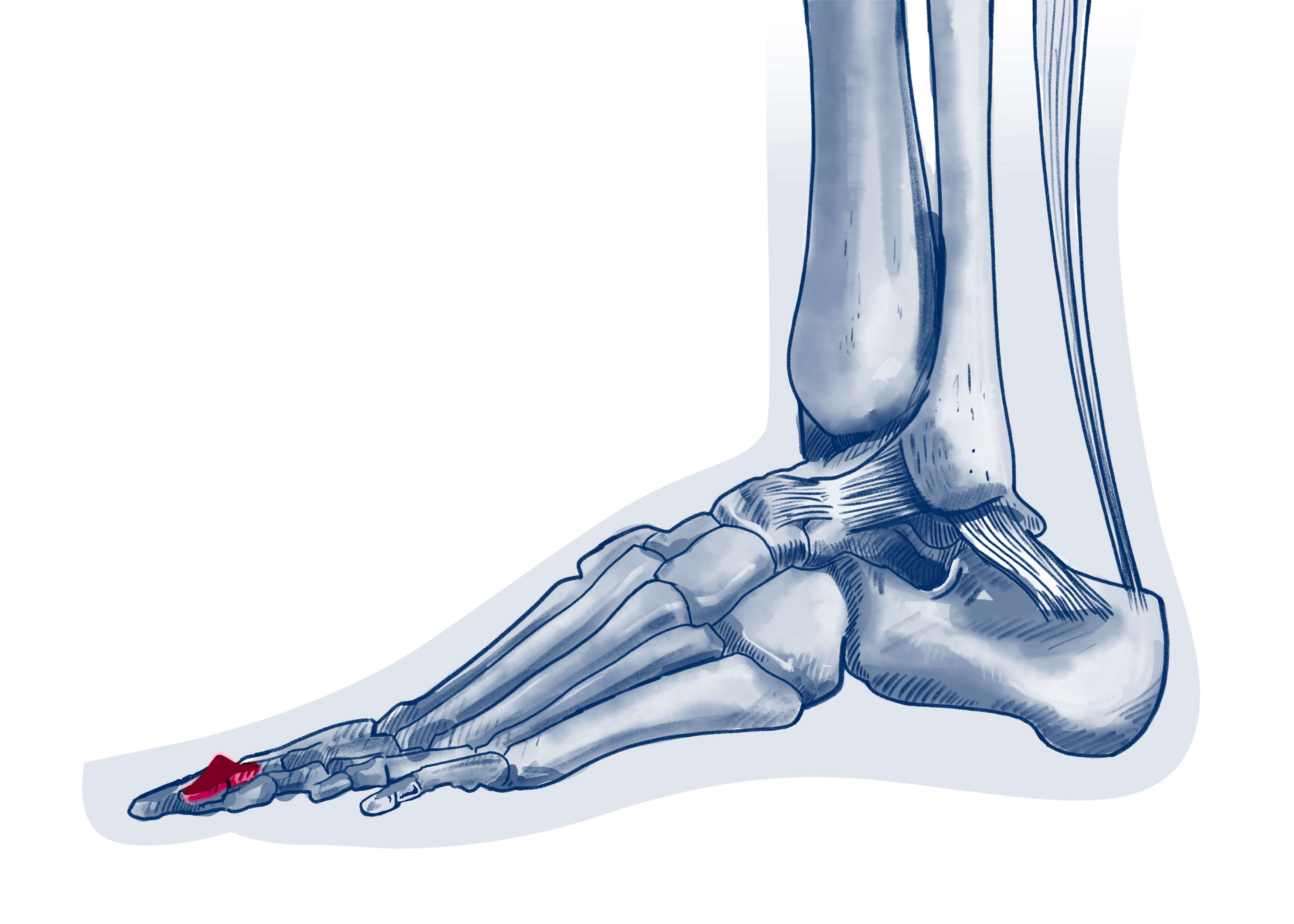 Griffe d'orteil - Pathologie | ISCO Strasbourg