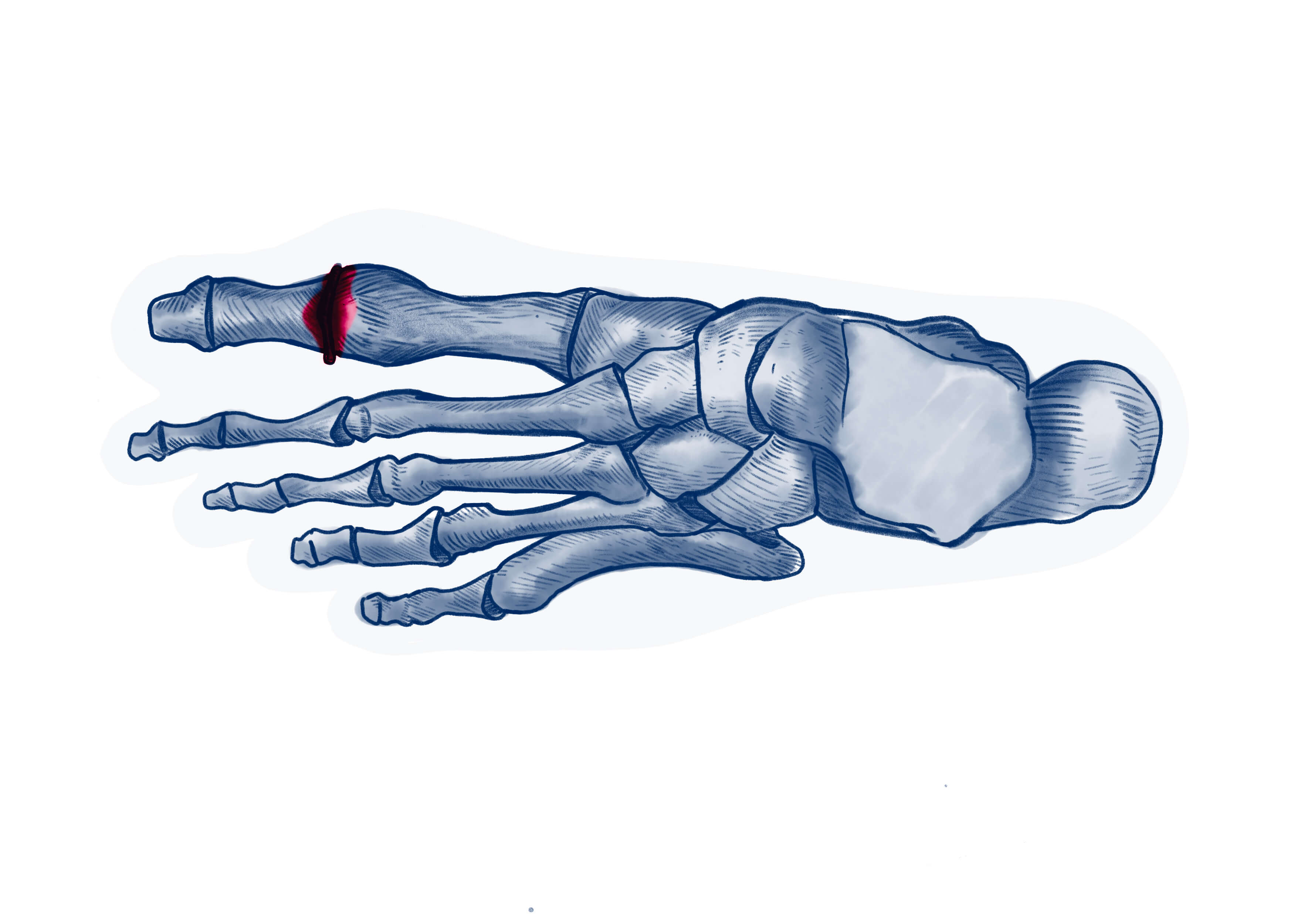 Hallux rigidus - Pathologie | ISCO Strasbourg