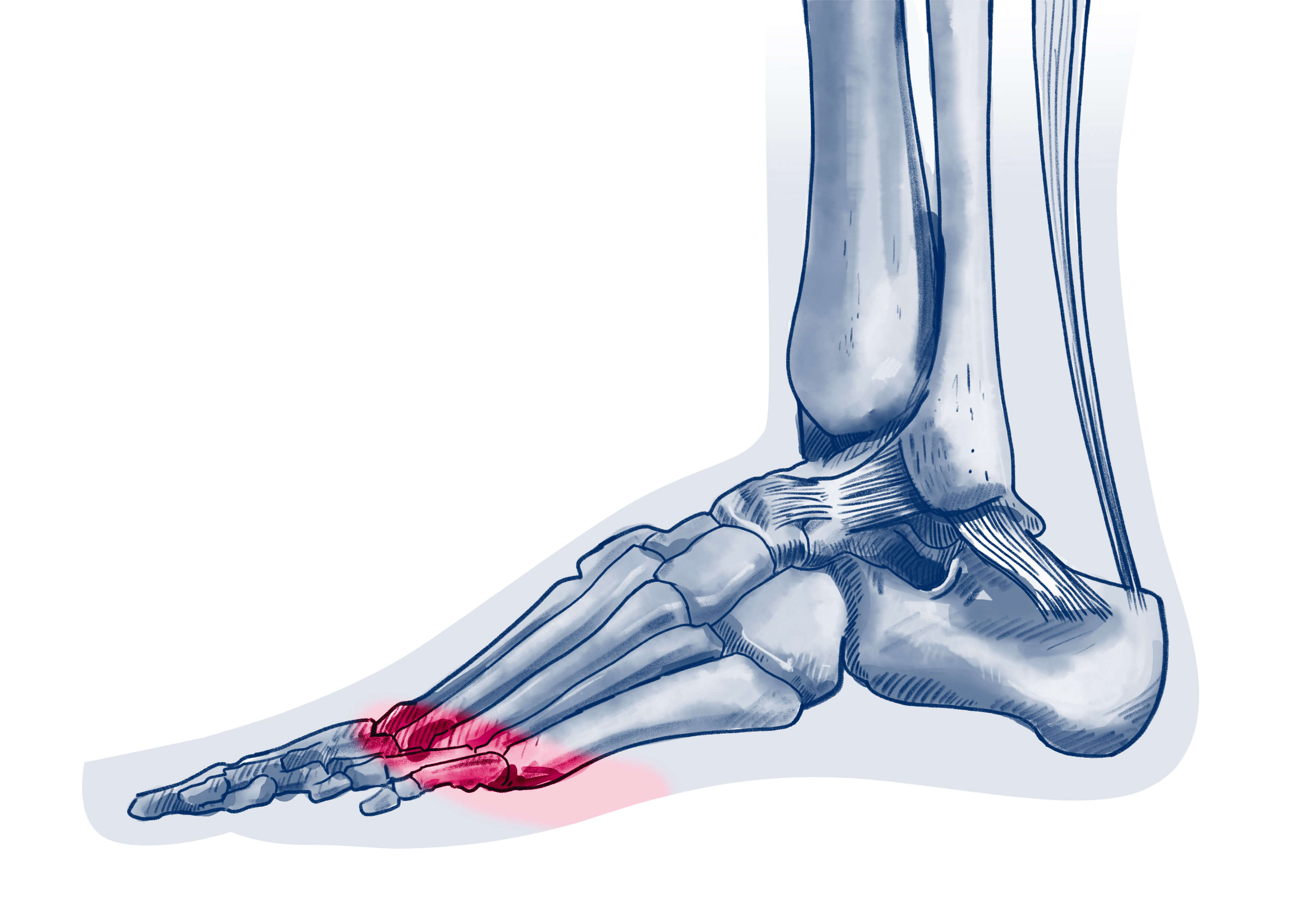 Métatarsalgie - Pathologie | ISCO Strasbourg