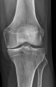 Image: Radiographie du genou dans l'arthrose - Édition professionnelle du  Manuel MSD