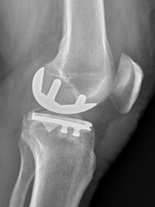 Arthrose du genou à Lyon - Chirurgie orthopédique - Prothèse