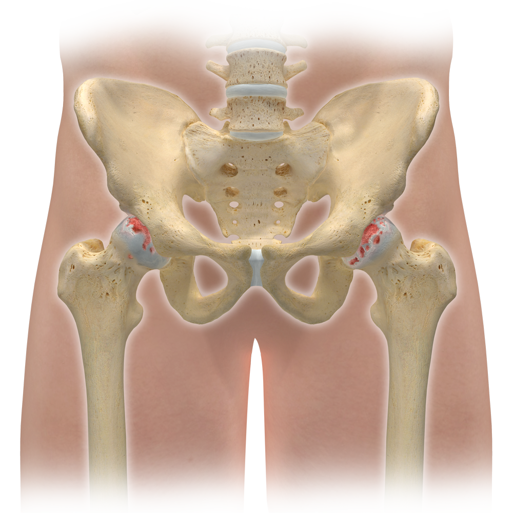 Arthrose de la hanche ou coxarthrose ISCO Institut Spécialisé de Chirurgie Orthopédique à