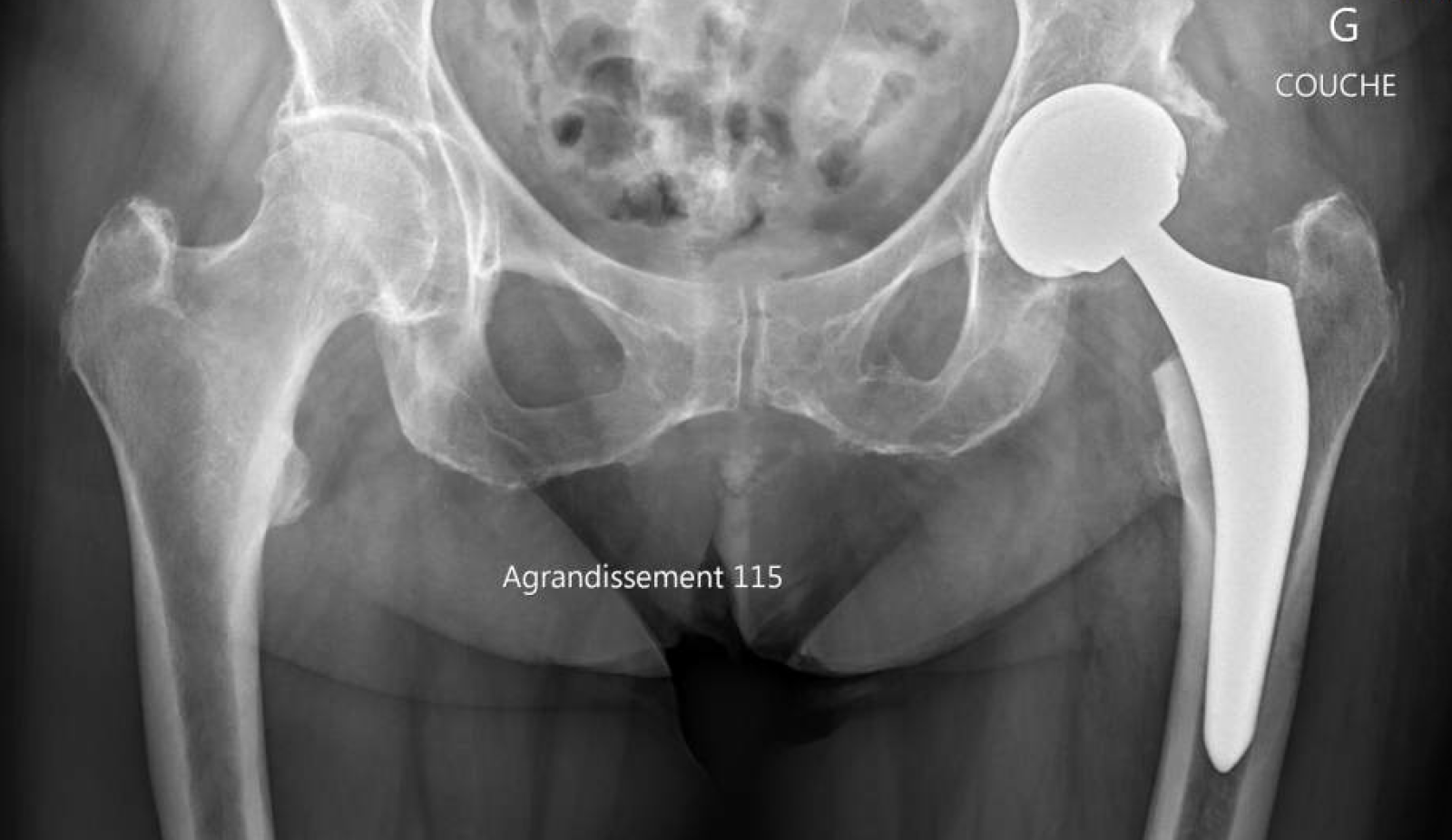 Coxarthrose avec pincement de l'interligne