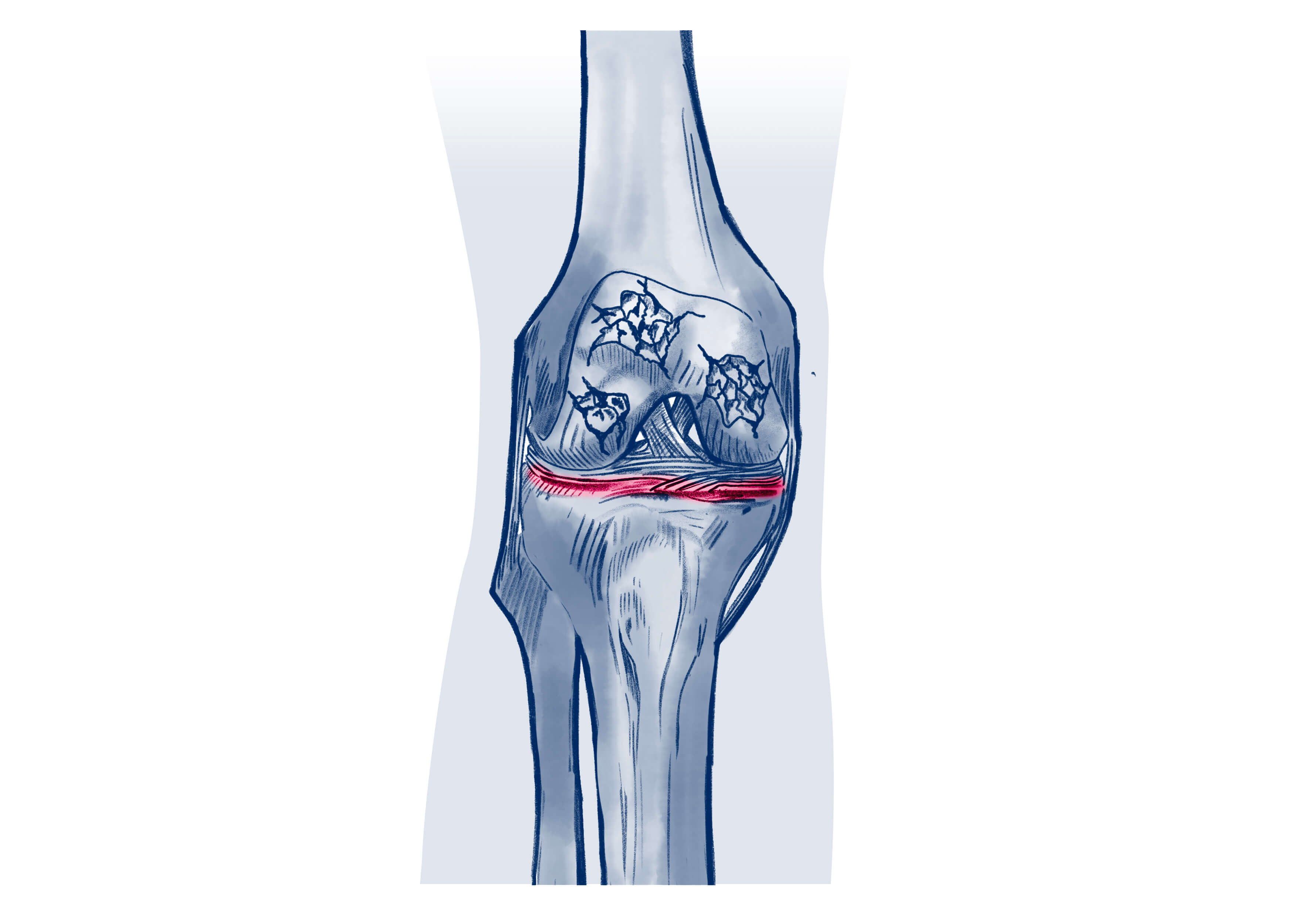 Arthrose du genou - Pathologie | ISCO Strasbourg