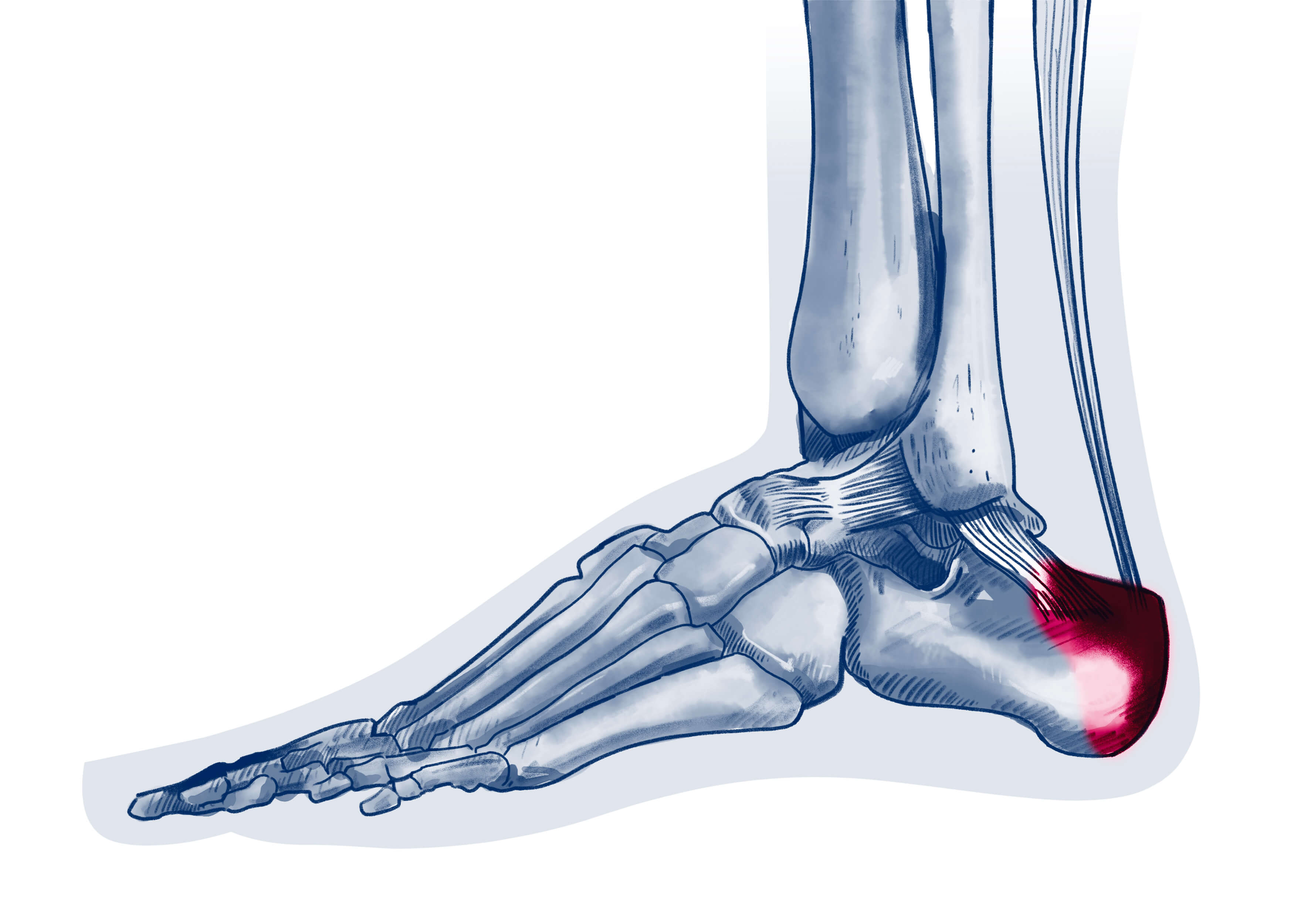 Maladie de Haglund - Pathologie | ISCO