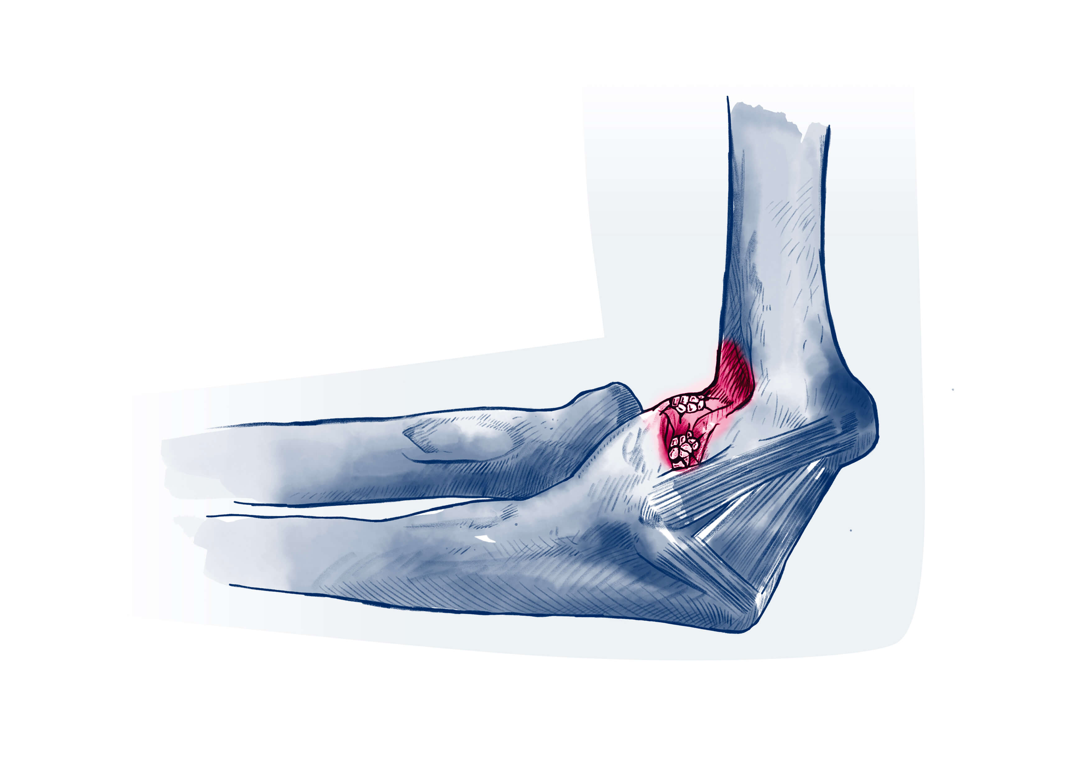 Arthrose Coude - Pathologie | ISCO Strasbourg