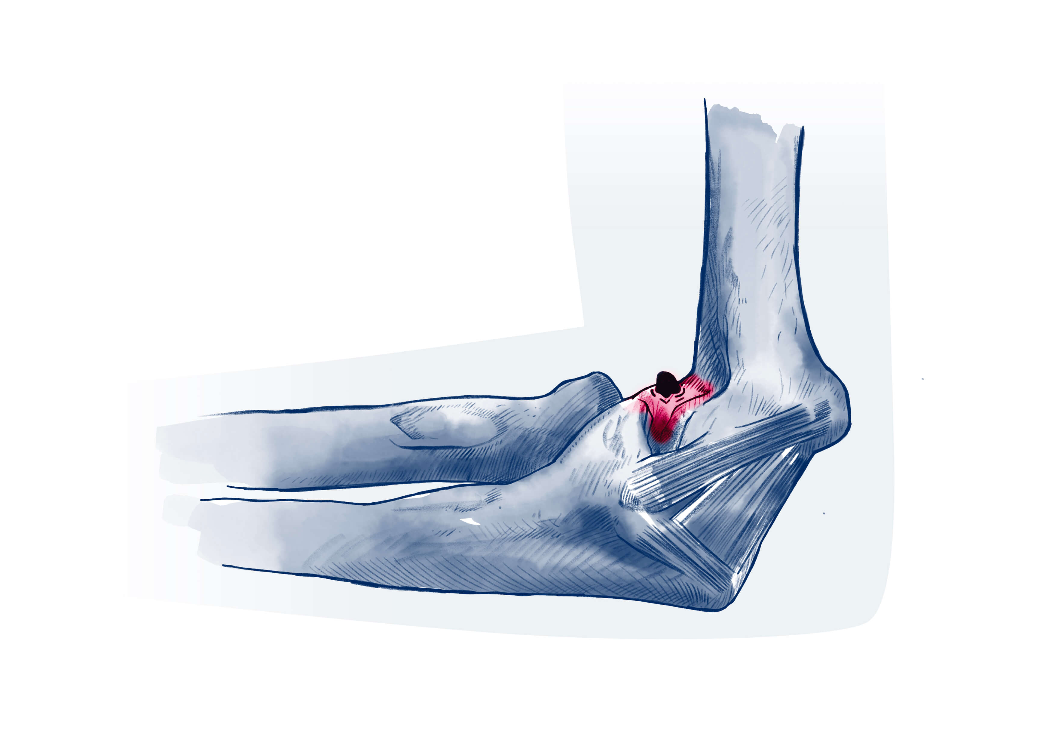 Corps étranger - Pathologie | ISCO Strasbourg