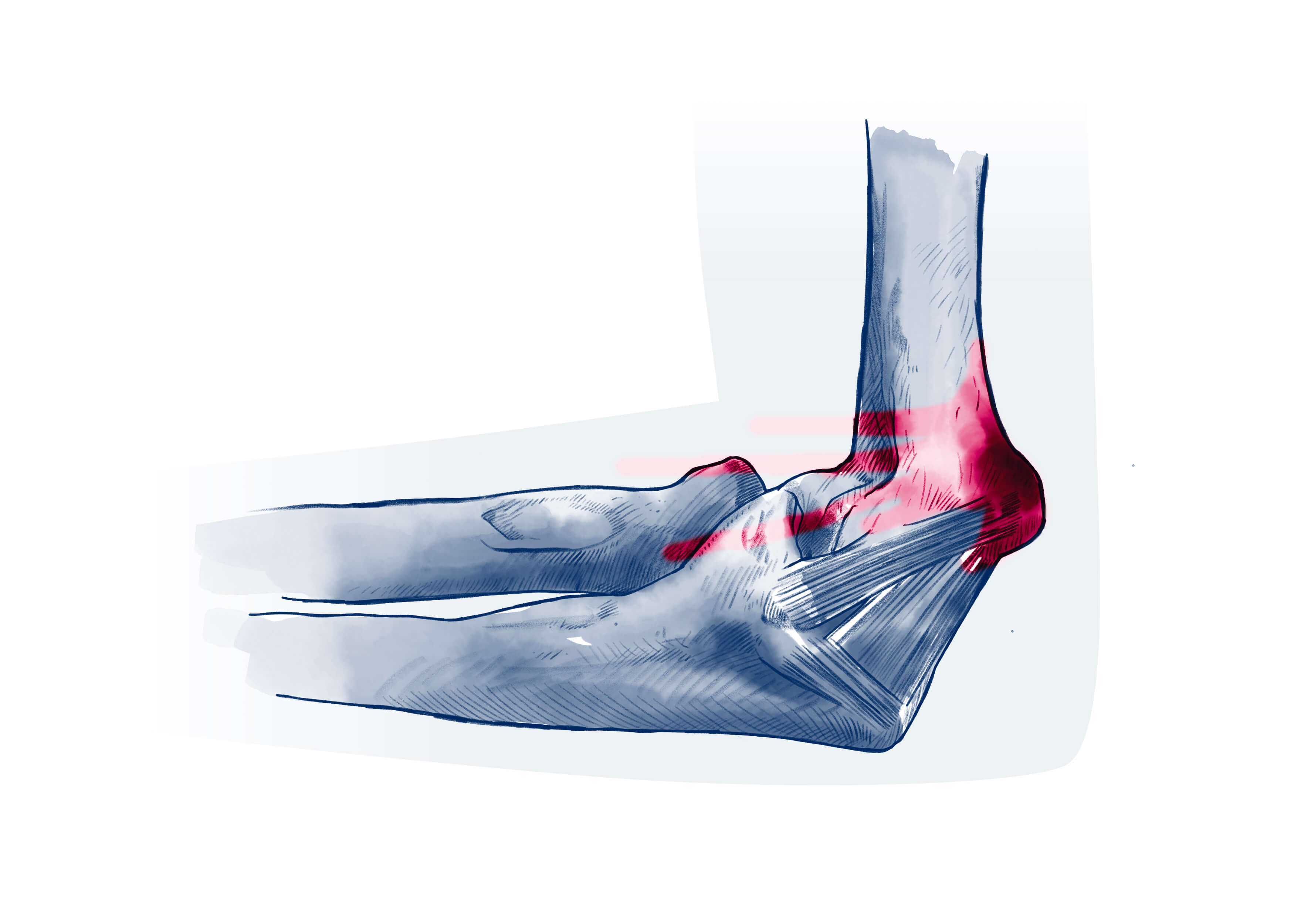 Epicondylite - Pathologie | ISCO Strasbourg