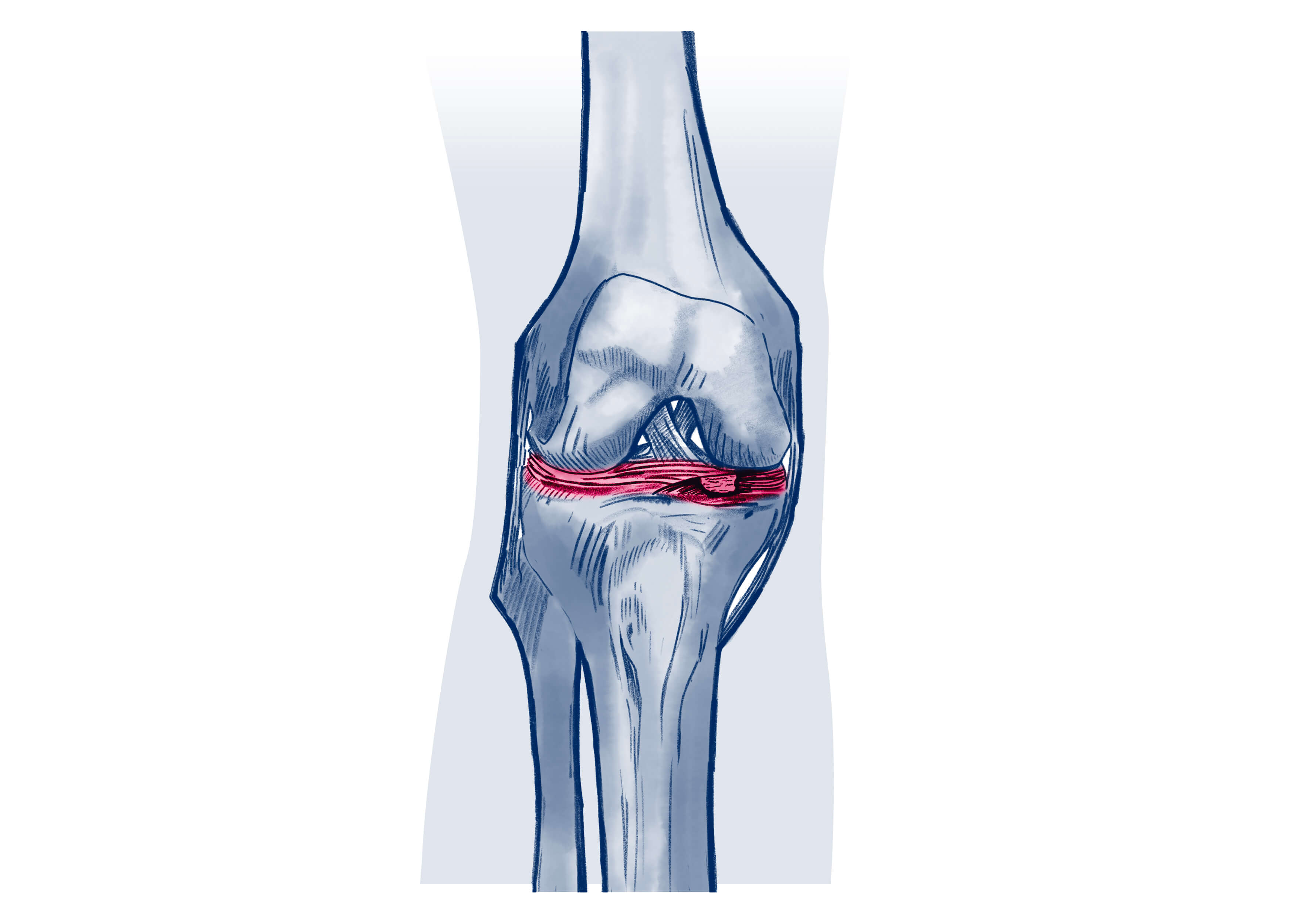 Lésion méniscale - Pathologie | ISCO Strasbourg